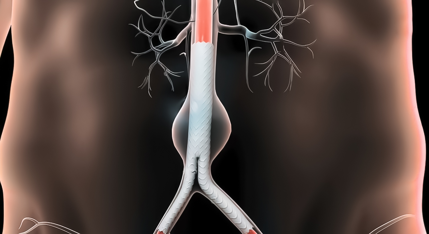 Abdominal Aortic Aneurysm (AAA) Treatment